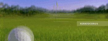 Keratoconus-GIF