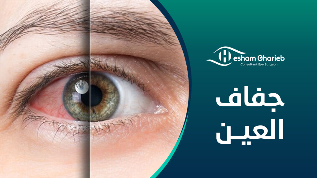جفاف العين