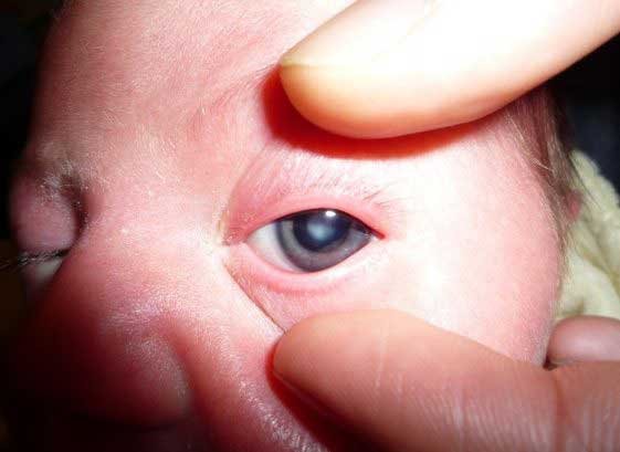 Laser Cataract Surgery