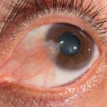 Pterygium