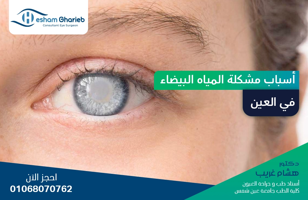 أسباب مشكلة المياه البيضاء في العين