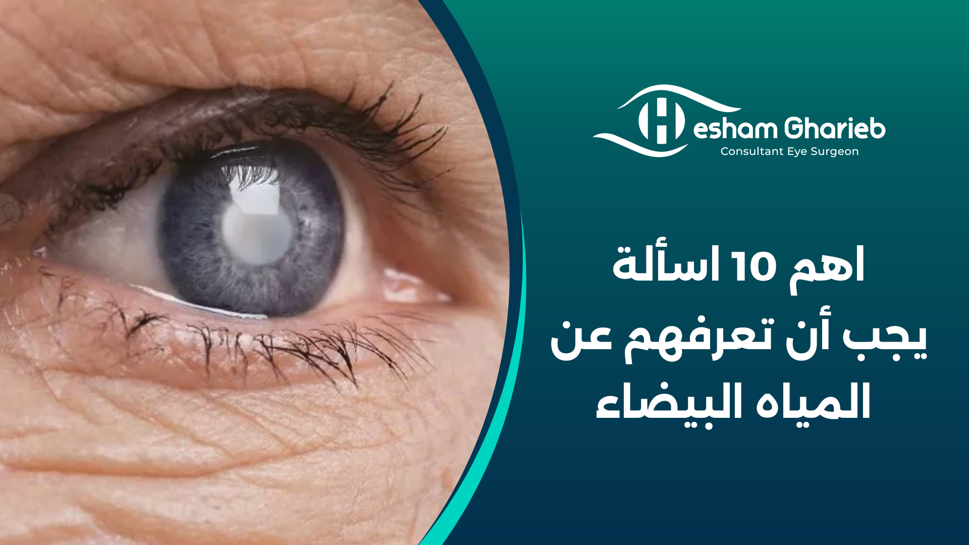 اهم 10 اسألة يجب أن تعرفهم عن المياه البيضاء