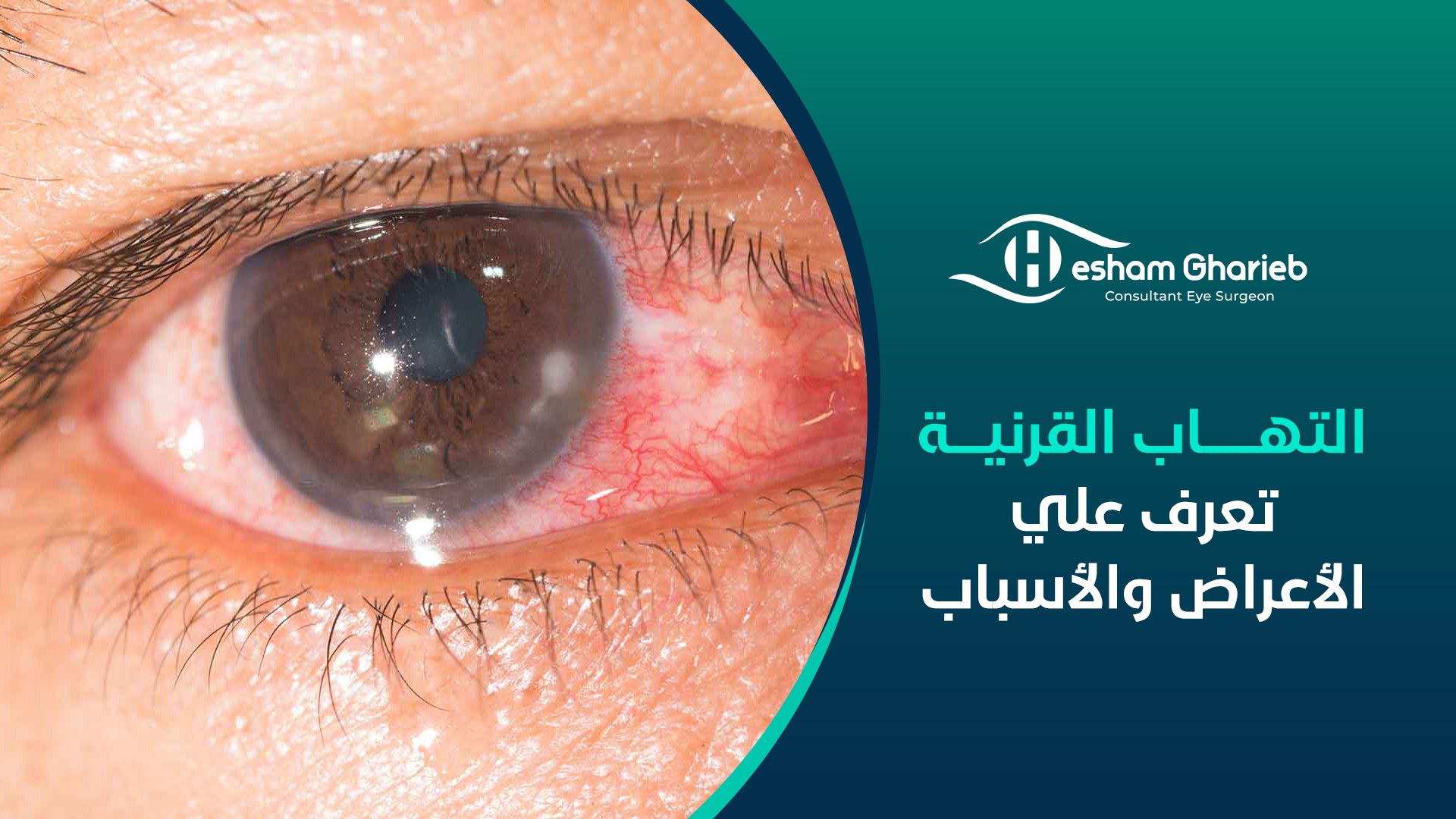 التهاب القرنية