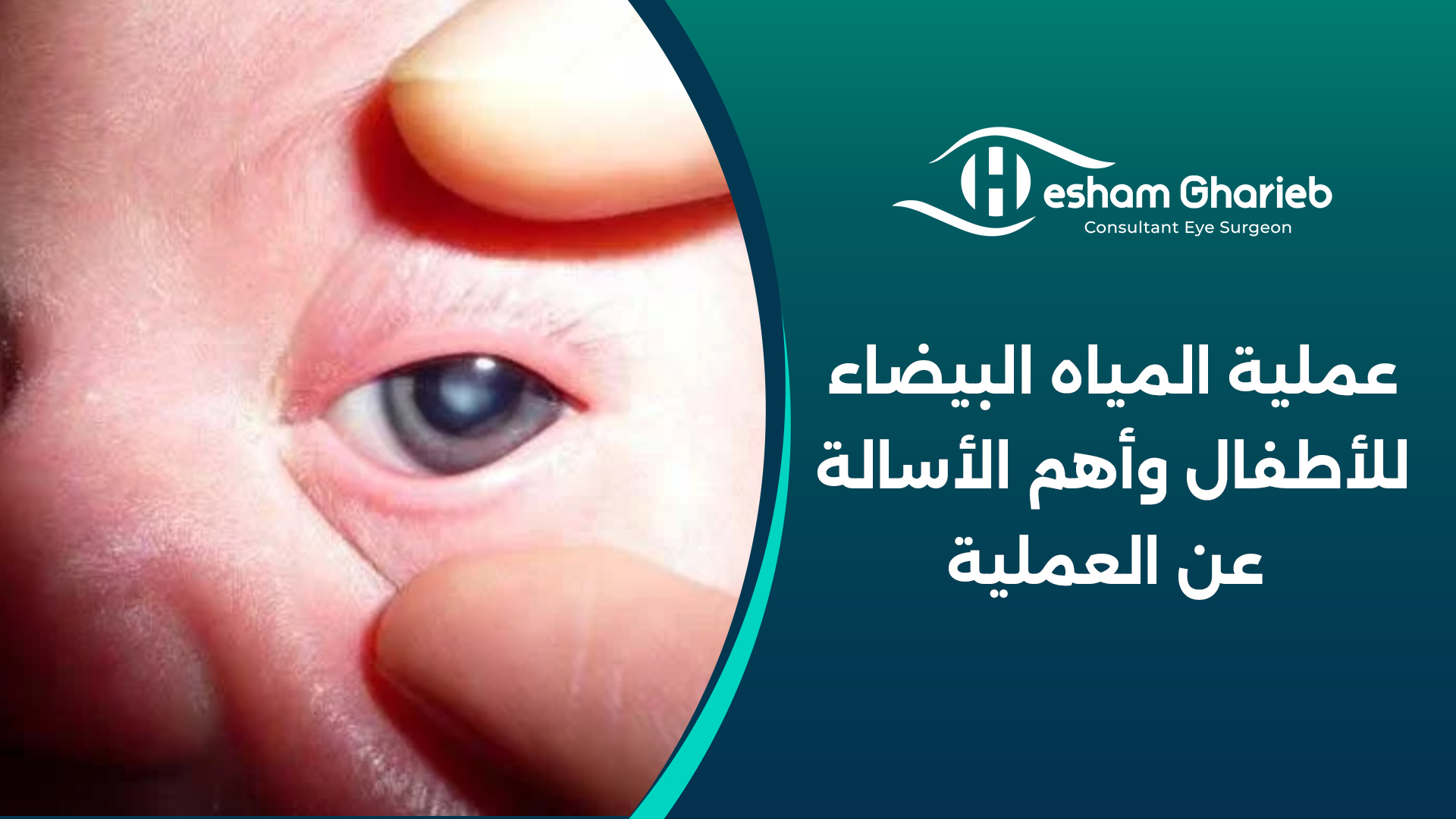 عملية المياه البيضاء للأطفال