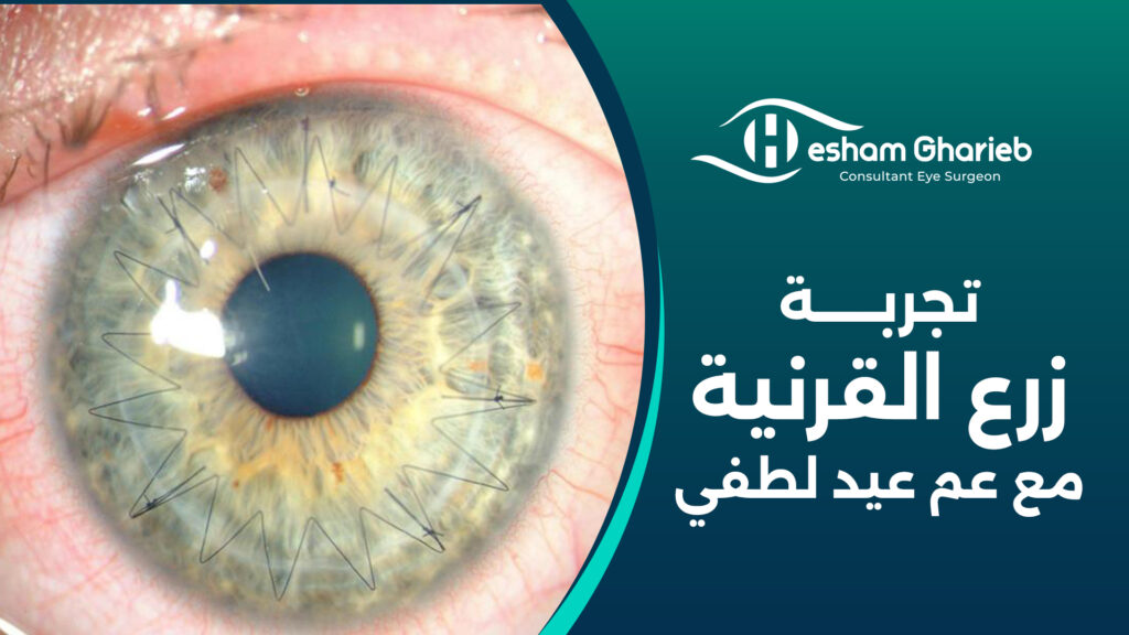 تجربة زرع القرنية مع عم عيد لطفي