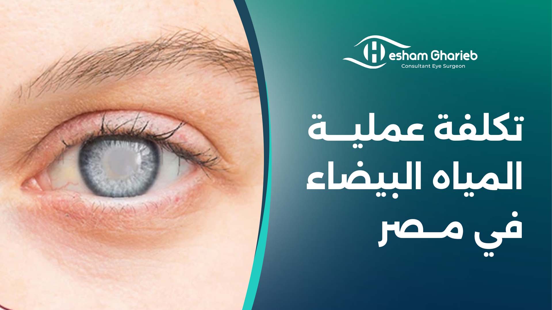 تكلفة عملية المياه البيضاء في مصر