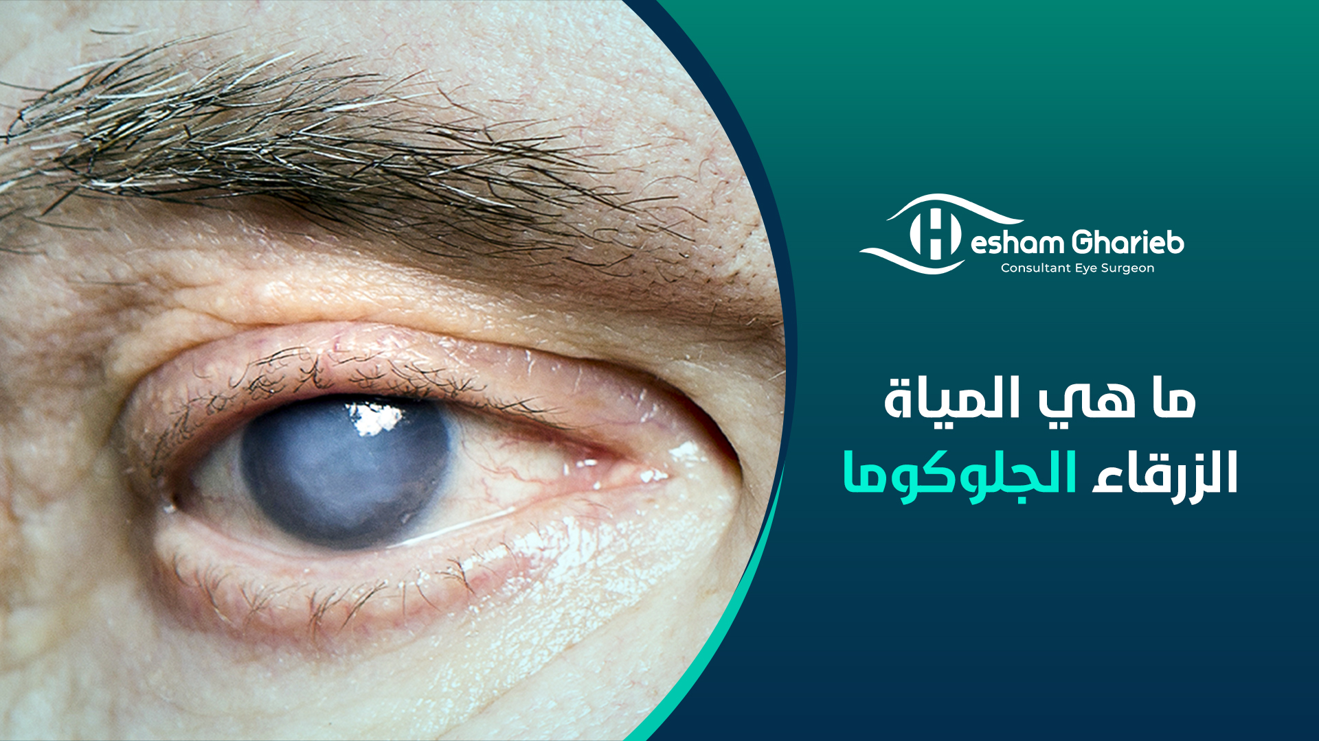 ما هي المياة الزرقاء الجلوكوما ما هي المياة الزرقاء الجلوكوما
