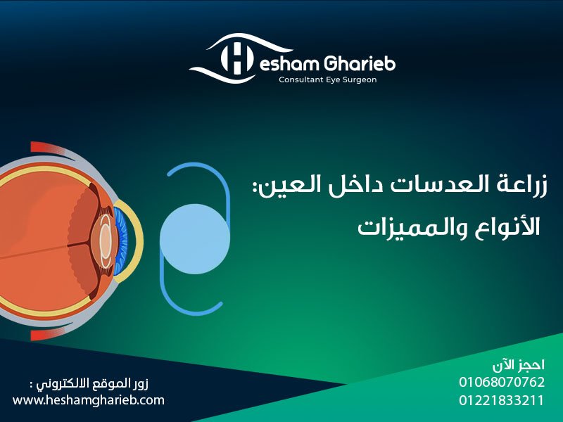 زراعة العدسات داخل العين