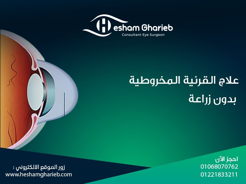 علاج القرنية المخروطية بدون زراعة: 3 خيارات آمنة وفعالة لراحة نظرك